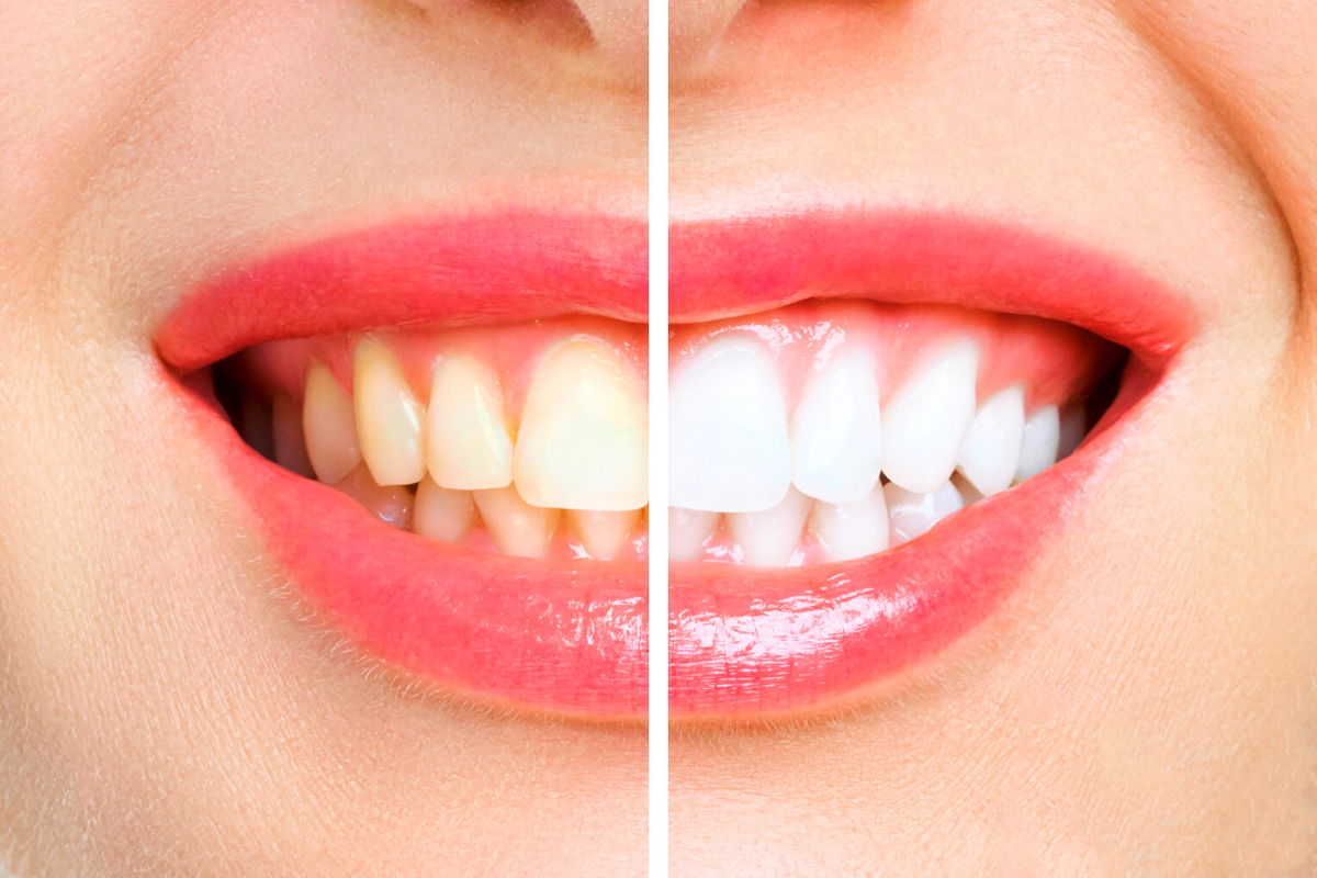 clarear os dentes-Foto: Canva Pro